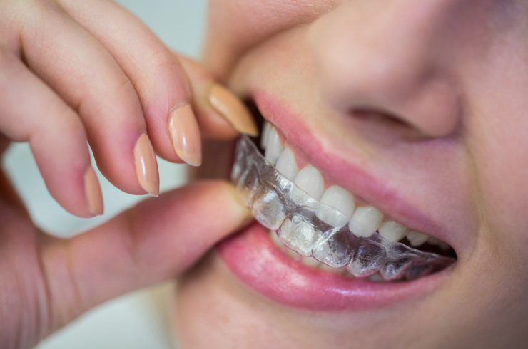 Aligners