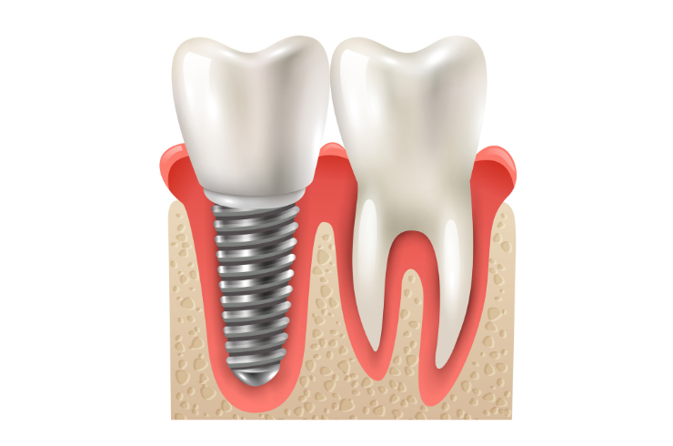 Implantology
